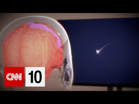 Elon Musk’s Neuralink implants chip in its first human brain | February 1, 2024